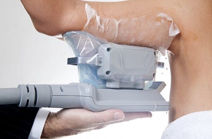 fat freezing arms Harwich