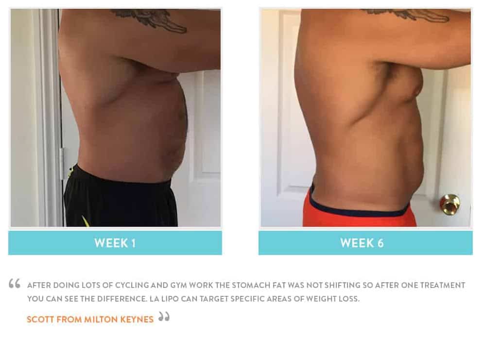 Before & After Stomach Fat Harwich