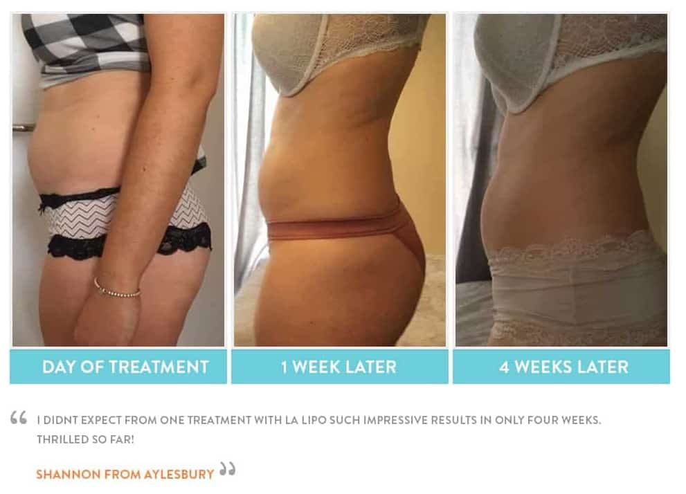 before, Cryolipolysis Harwich