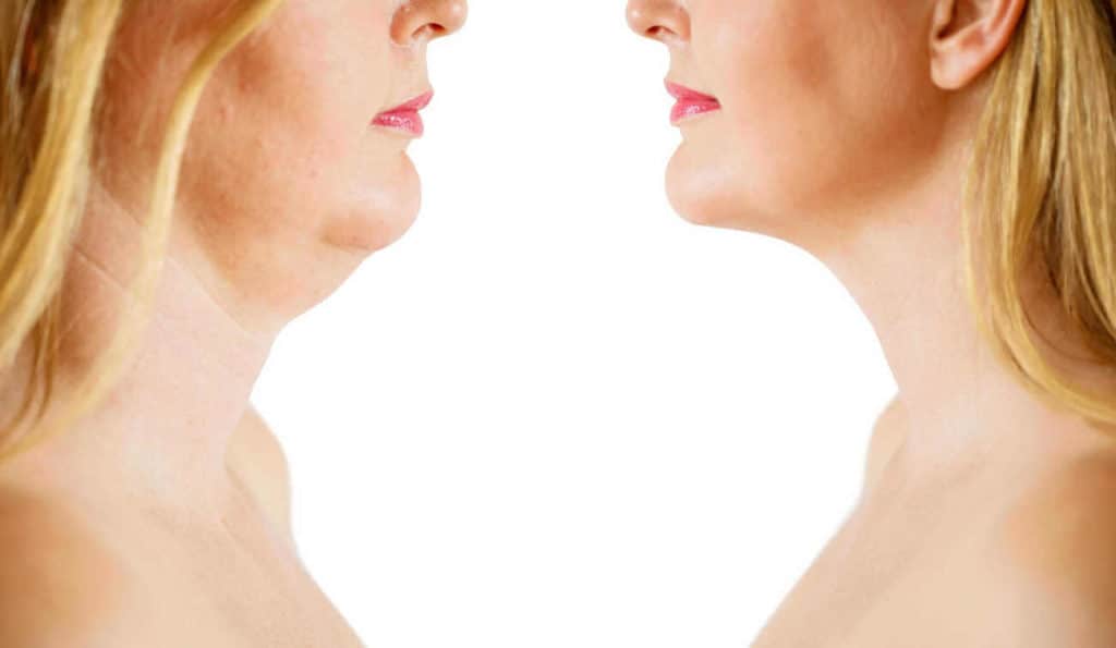 Double Chin treatment Harwich before and after results