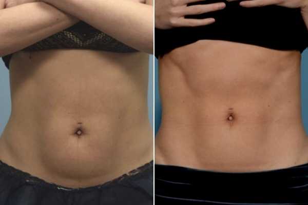 body sculpting FAQs Harwich