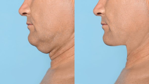 Which Non-Surgical Treatments Work Best for Jowls and Loose Skin Harwich?