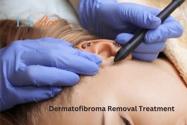 Dermatofibroma Removal Treatment Harwich