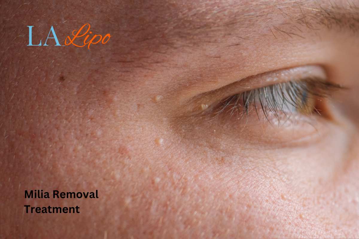 Cryopen Milia Removal: Is It the Easiest and Safest Option Harwich?