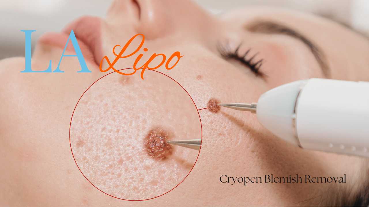 cryopen blemish removal Harwich Contact our team today!