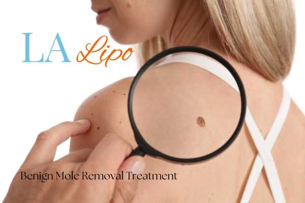 Why getting moles removed Harwich can boost your confidence!