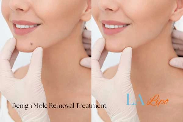 woman's before and after mole removal Harwich results