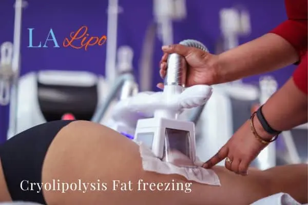 women getting fat freezing Harwich
