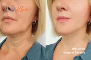hi-fu for wrinkles Harwich before and after results