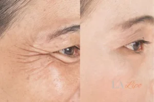Before and after results of woman - HI-fu wrinkles reduction treatment Harwich