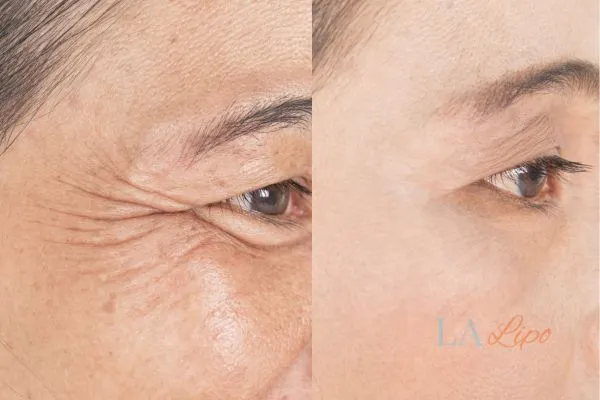 Before and after results of woman - HI-fu wrinkles reduction treatment Harwich