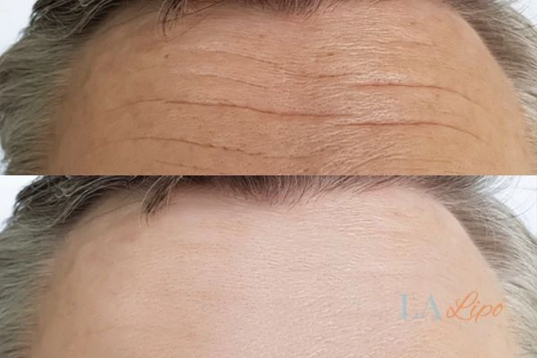 results of HIFU Harwich on mans forehead to help reduce lines and wrinkles