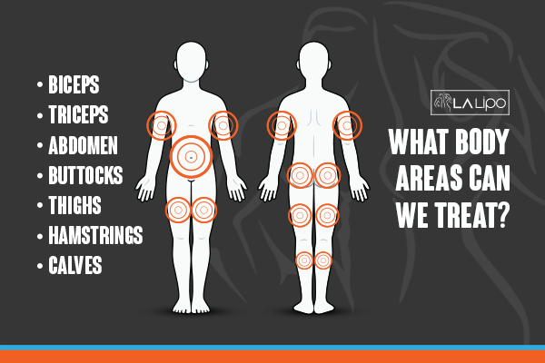 Graphic to show areas you can have LA-EMS Body Sculpting Harwich treatment.