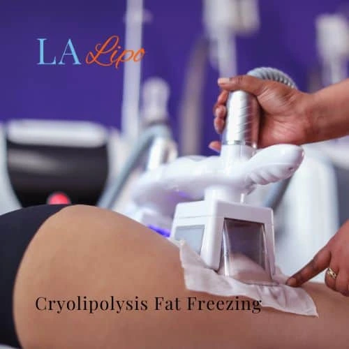 fat freezing - Cryolipolysis Harwich