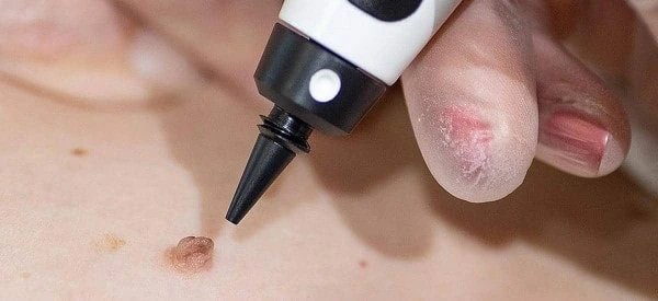 skin tag removal using cryopen Harwich