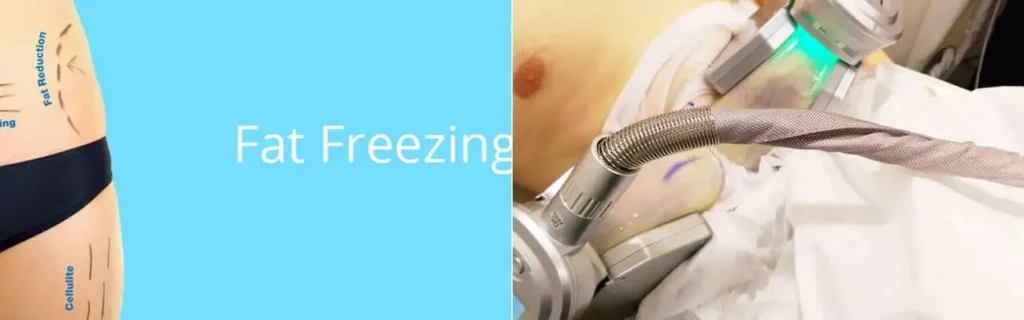 Fat freezing Harwich on multiple areas of the body