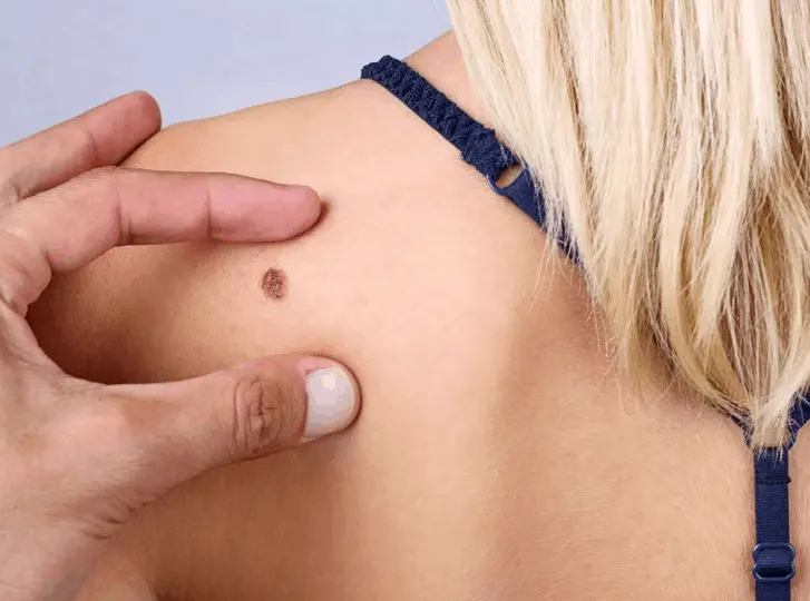woman having mole removal Harwich consultation before treatment.