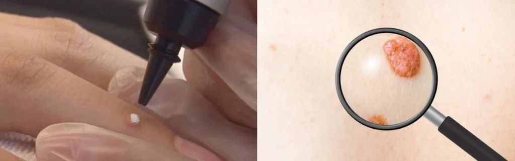 Person getting moles removed with cryopen Harwich