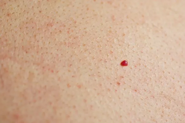 close up of a cherry angioma Harwich
