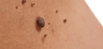 image of a skin tag Harwich