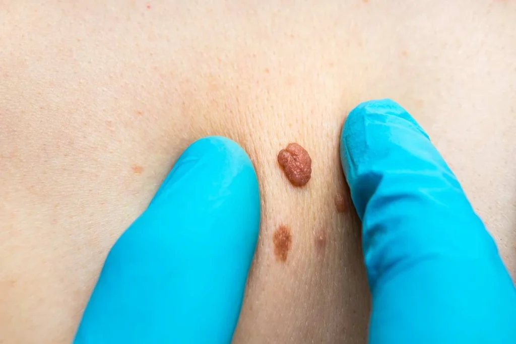 Consultant examining a skin tag Harwich