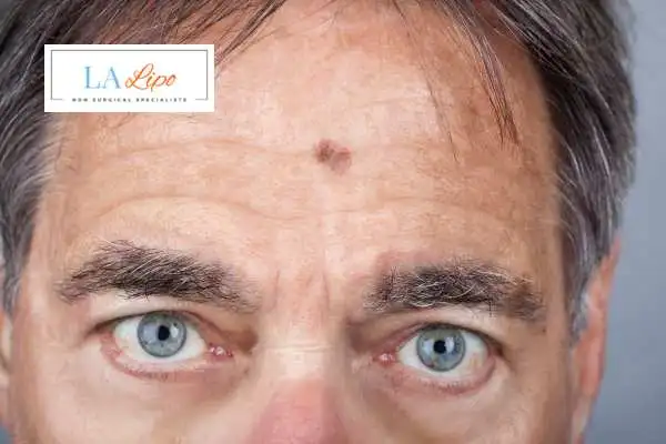Solar Lentigo Removal Harwich image of man with mark on his forehead