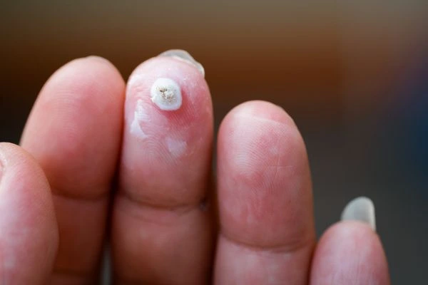 wart on person finger - cryotherapy to treat from LA LIPO Harwich