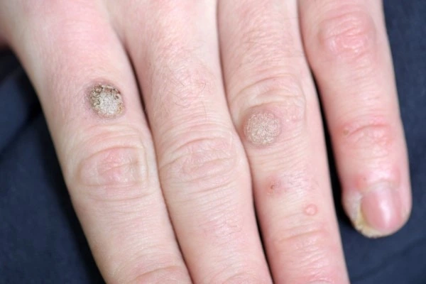 photo of warts on person hand - see wart removal Harwich from LA LIPO
