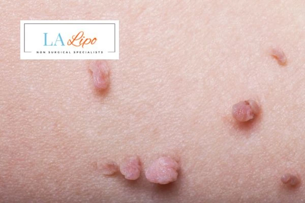 Does cryopen skin tag removal Harwich hurt? Find out now call our team today!