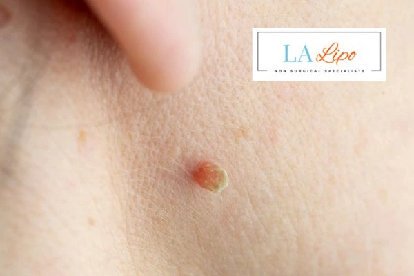 Book skin tag removal Harwich today speak to our team now!