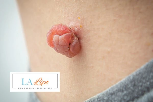 Interested in skin tag removal Harwich? Concerned about the pain? Find out more today!
