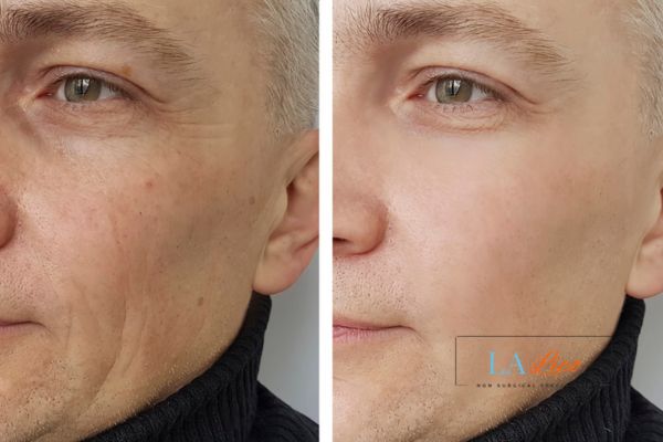 See the amazing results of Morpheus8 Treatment Harwich!