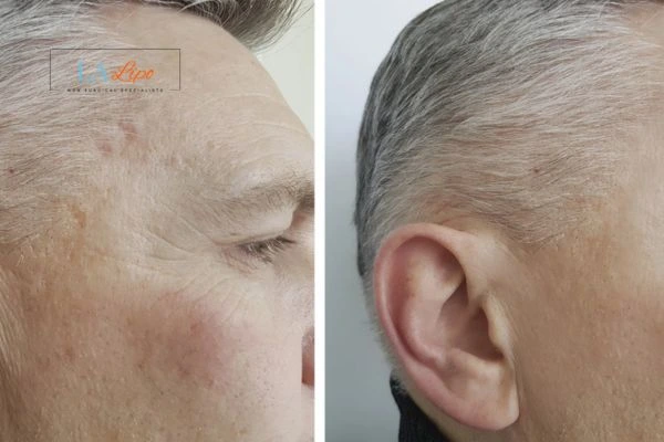 Mens Before & After Morpheus 8 Results Harwich