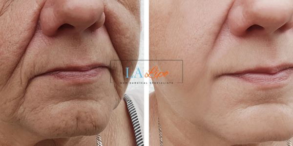 Older lady deeper wrinkle reduction - LA LIPO Morpheus 8 Results Harwich