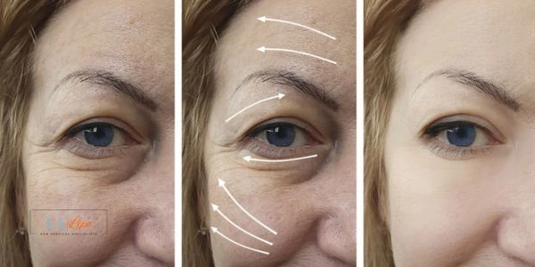 Amazing eye lift Morpheus 8 results Harwich