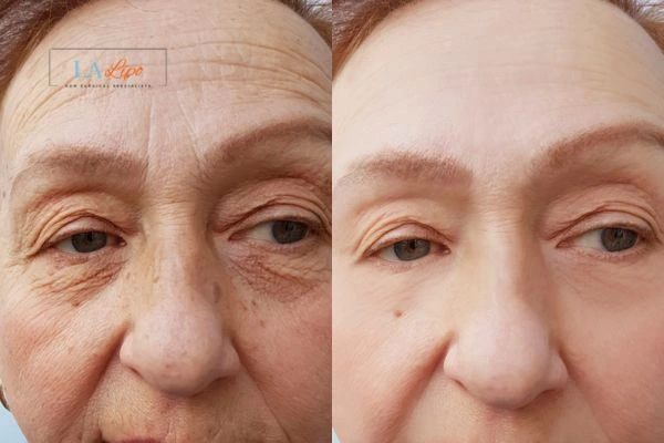 The powerful benefits of Morpheus8 Treatment Harwich - Call Our team today!
