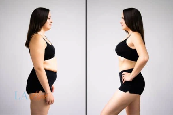 Picture of womans before and after using LA-EMS body sculpting to improve her core strength Harwich