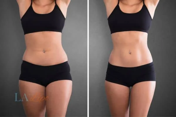 before and after results of non-surgical treatment to help a woman's body image and mental health Harwich