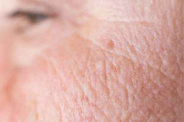 close up picture of a woman's face showing an age spot Harwich