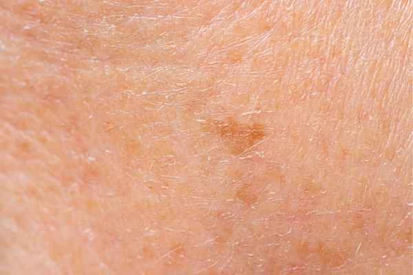 close up picture of age spots Harwich