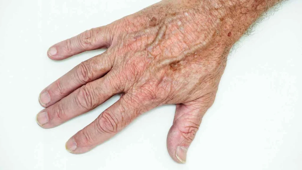 Male hand showing age spot Harwich