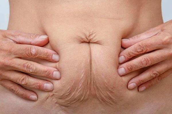 Image of a woman's stomach with loose skin - example of skin tightening Harwich options