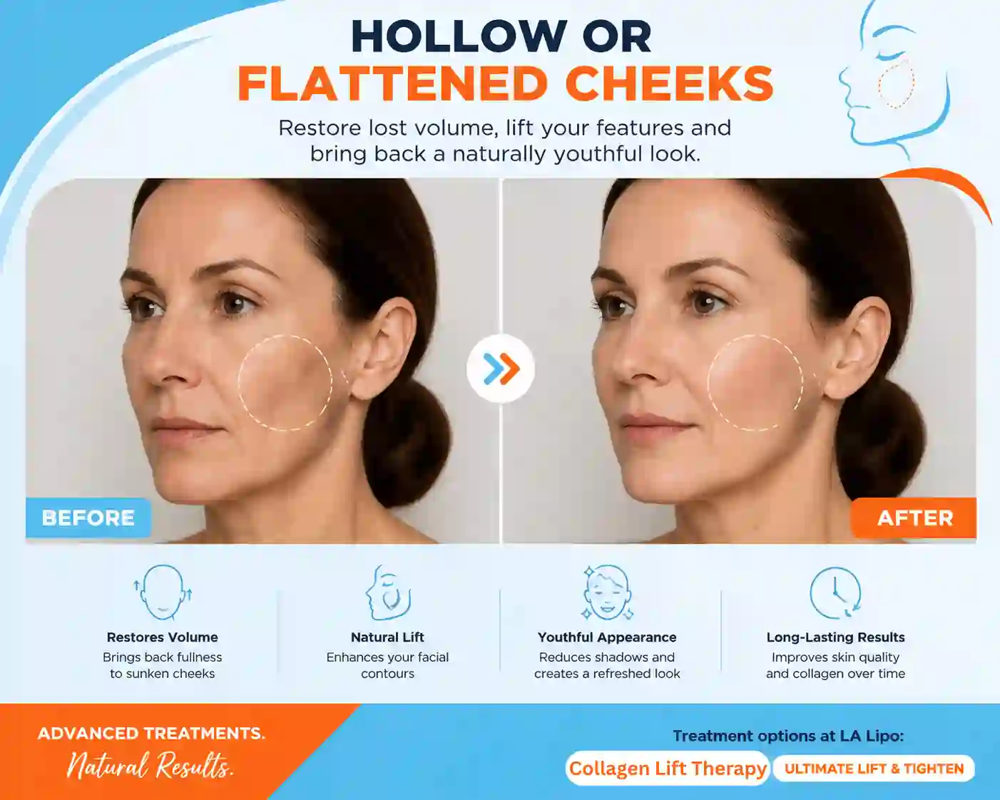 Sign #4: Hollow or Flattened Cheeks Harwich